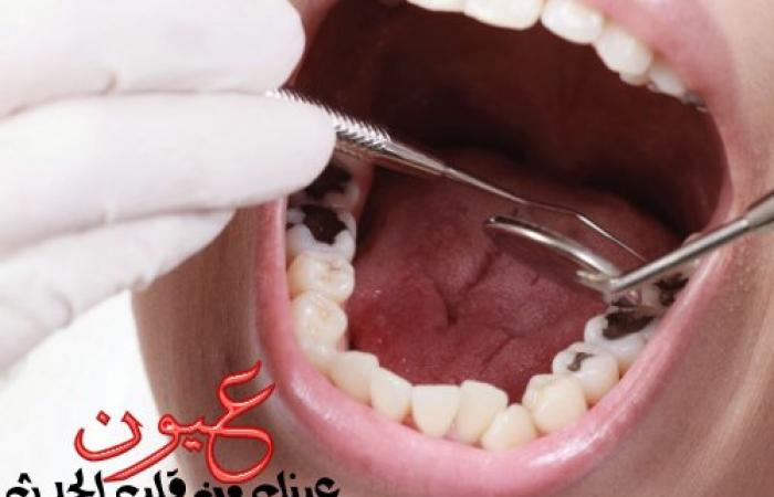 علاج تسوس الأسنان فى المراحل المبكرة والمتقدمة