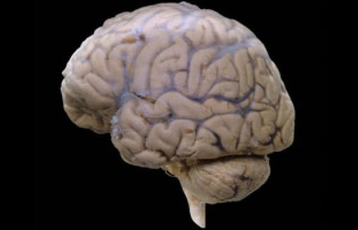 دراسة: صغر حجم المخ سبب الصداع النصفى المتكرر