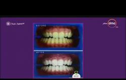 السفيرة عزيزة - د/ شريف الغر يعرض بعض الصور التوضيحية لعمليات " تبيض الأسنان "