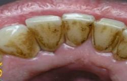 طريقة إزالة الرواسب البيكتيرية من باطن أسنان الفم بطريقة سهلة وغير مكلفة