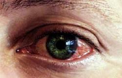 أستاذ طب عيون: يوضح أسباب ضعف العيون الملونة عن غيرها