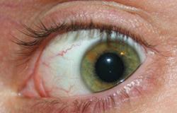 ابتكار جهاز جديد لعلاج جفاف العين يعمل بالوايرلس