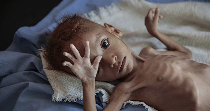 فتى يعاني من الكوليرا سوء التغذية الحاد يقع على سرير في مستشفى في مركز صحي في حجة باليمن