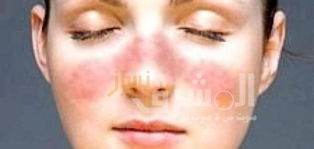علاج قشرة الوجه - بثلاث مكونات طبيعية.. عمل ماسك تقشير الوجه