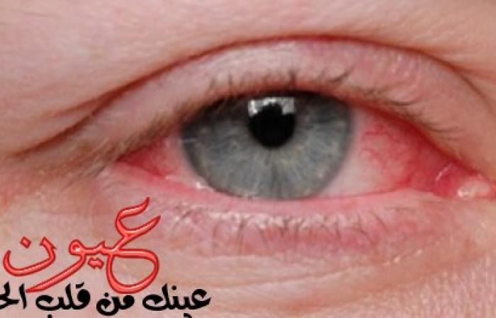 تعرف على أكثر أمراض العيون انتشارا بمصر.. والفرق بين الرمد الحبيبى والربيعى