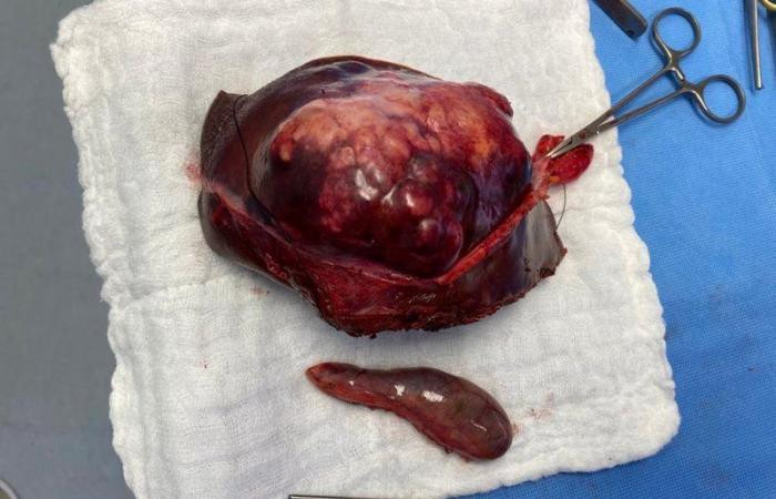 عملية ناجحة لاستئصال أحد فصي الكبد بالمنظار الجراحي في مستشفى عسير