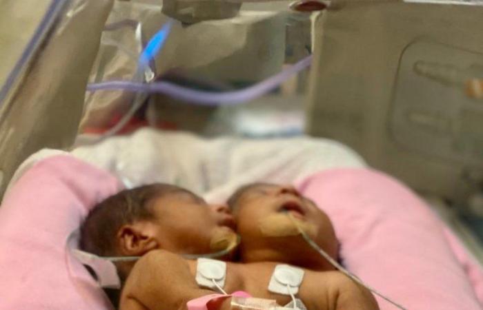 "مستشفى الولادة" ينقذ حياة طفلين "سياميين" من "توقف القلب" بمكة