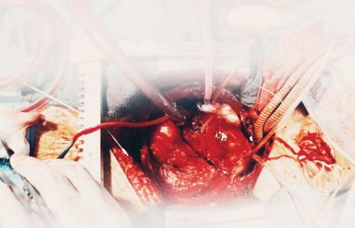 إيقاف القلب والرئة وسحب جميع دم المريض في جراحة نوعية بـ"تخصصي جدة"