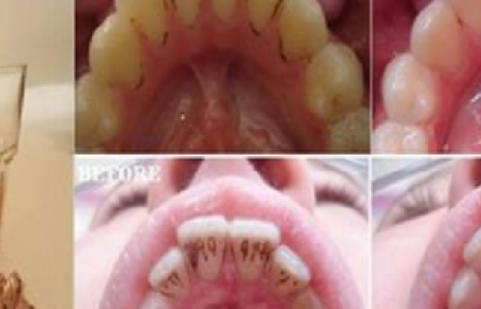  فوائد قشر الجوز فى التخلص من ترسبات الاسنان وجعلها بيضاء ولامعة