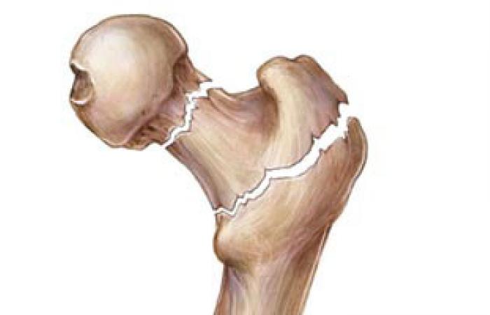 "الجهاز الفضائى" تقنية تساعد فى علاج تشوهات العظام