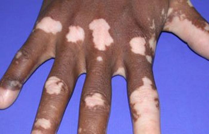 إهمال علاج البهاق يؤدى إلى الإصابة بسرطان الجلد