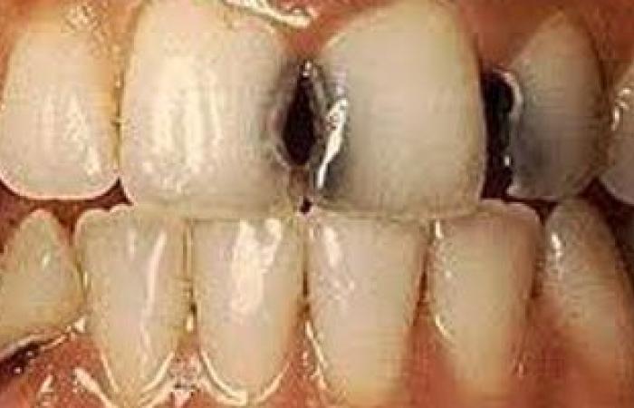 التهابات اللثة وتسوس الأسنان تسبب اضطراب المعدة والقولون