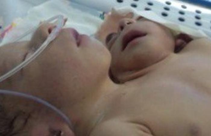 ولادة طفلة برأسين وأربعة أذرع وقلب واحد بمستشفى شبين الكوم بالمنوفية
