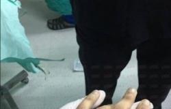 بالفيديو.. عملية جراحية لتركيب يد شاب الشرابية «المبتورة»