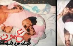 صور سيرا الطفلة الملقبة بـ "الكلب المرقط" بعد أن أصبح عمرها 19 عاماً
