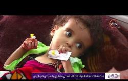 الأخبار - مرضى السرطان .. ضحايا آخرون للحرب في اليمن