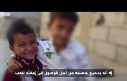 أنا الشاهد: طفل يمني يتحدى الإعاقة ويحلم أن يكون طبيبا