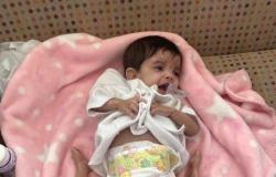 فصل التوأم الطفيلي اليمني.. بدء إجراءات الفحص والعملية تستغرق 8 ساعات