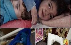 الطفلة السورية التي هزت العالم.. باتت "أميرة" لكن يتيمة