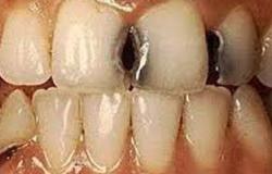 دراسة: تسوس الأسنان يصيب 35% من سكان العالم