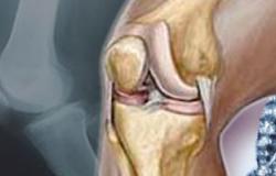 كيفية علاج احتكاك الركبة؟