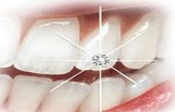 أطباء: إكسسوارات الأسنان تجعلها أكثر عرضة للتسويس