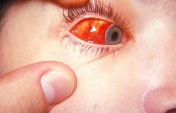 كيف يعالج كسل العين عند الأطفال؟
