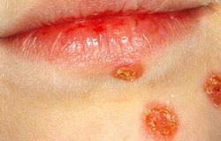 "الإريثرازما" مرض جلدى تتشابه أعراضه مع التينيا والصدفية