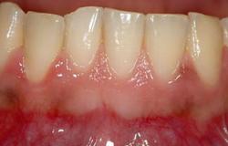 أستاذ طب أسنان: فقر الدم يؤدى إلى نزيف اللثة