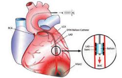 جهاز تنظيم ضربات القلب يساعد على علاج ارتفاع ضغط الدم