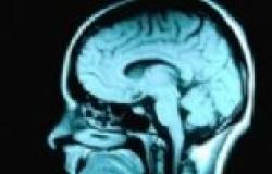 زيادة الحديد في المخ مؤشر على زيادة مخاطر الإصابة بالتصلب العصبي المتعدد
