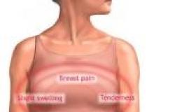 تورم الغدد الليمفاوية تحت الإبط ضمن أعراض الإصابة بسرطان الثدي
