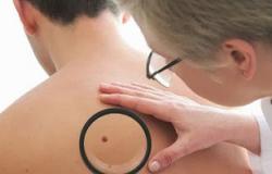 استشارى أمراض جلدية: أشعة الليزر الأفضل فى علاج "وحمات الجلد"