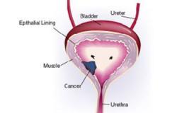 دراسة: سرطان الخصية يرفع معدلات الإصابة بأورام البروستاتا