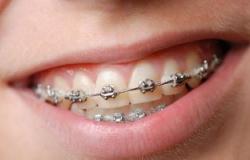 أهم الأعراض المصاحبة لتقويم الأسنان وطرق علاجها