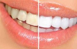 7 نصائح ضرورية للتخلص من اصفرار الأسنان