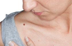 انتبه.. كثرة الشامات علامة على ارتفاع خطر الإصابة بسرطان الجلد