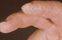 أخصائى جلدية: غسيل الصحون بمنظفات كيميائية يشكل خطورة صحية