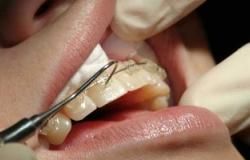 دراسة نرويجية: أضرار حشو الأسنان أكبر من فوائده لأنه يتسبب فى التسوس