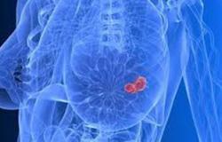 سرطان الثدى يتحدد بأشعة الماموجرام المقطعى ثلاثى الأبعاد