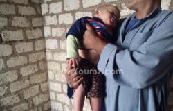 بالصور.. الطفل محمد بالمنيا أجرى 25عملية ويحتاج 10 آلاف جنيه لإنقاذ قدمه