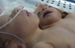 نقل الطفلة المولودة برأسين وأربع أذرع لمستشفى أبو الريش لعدم استقرار حالتها