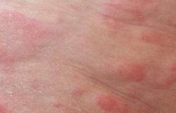 أستاذ جلدية: الليزر الجزيئى أحدث طفرة فى علاج الحروق وتشوهات الجلد