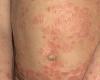 سرطان الغدد الليمفاوية يظهر على شكل بقع متورمة بالجلد